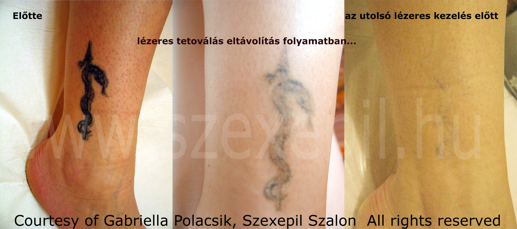 lézeres tetoválás eltávolítás folyamata, lérezes tetoválás eltávolítás ára
