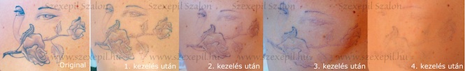 test tetoválás eltávolítása lézerrel, tetoválás eltávolítása folyamata lézerrel tetoválás eltávolítás ár,  tetoválás előtte utána